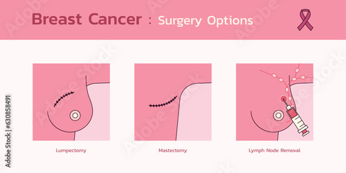Breast Cancer Surgery Options, A Comprehensive Infographic on Treatment Choices and Decision Making, Vector Flat Design Medical Illustration