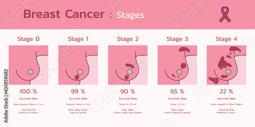 Medical Infographic, Navigating Breast Cancer Stages for Informed Decisions and Awareness, Vector Flat Design Illustration