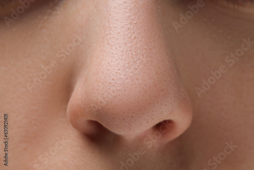 Young woman with acne problem, closeup view of nose