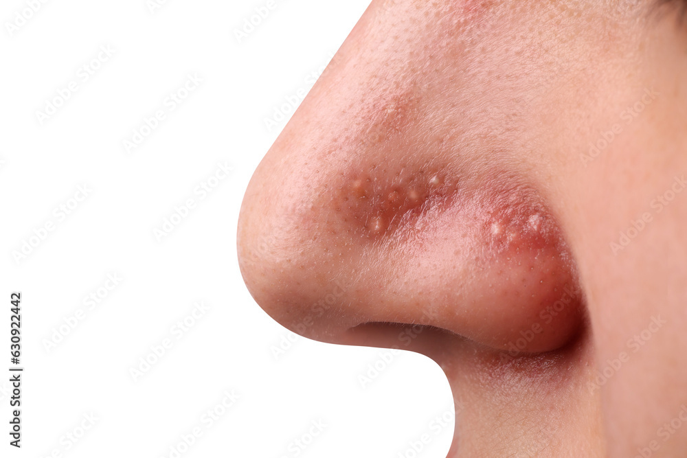 Young woman with acne problem on grey background, closeup Young woman with acne problem on grey background, closeup