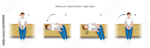 Casani Gufoni maneuver right side