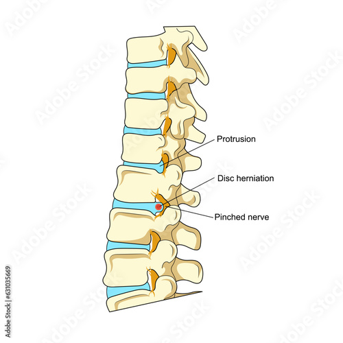 Spinal disc herniation diagram schematic vector illustration. Medical science educational illustration