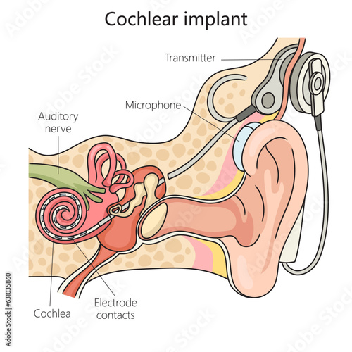Cochlear implant structure vertebral column diagram schematic vector illustration. Medical science educational illustration