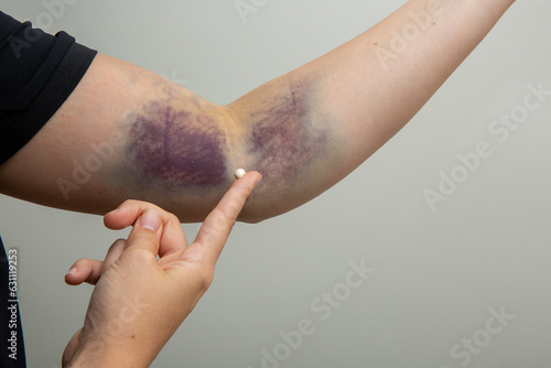 Applying ointment to a fingertip to massage a bruise on an arm. photo
