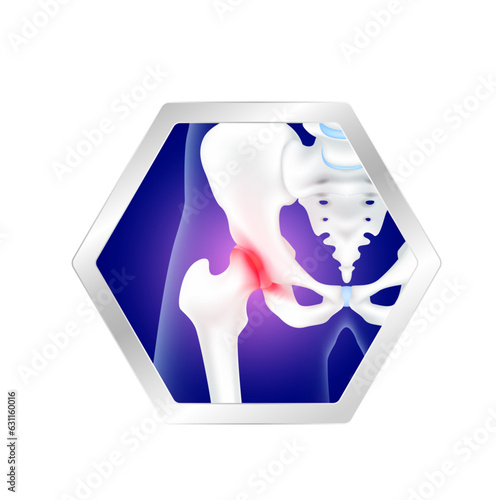 Hip bone, pelvis and degenerative joint in hexagon label aluminum. Arthritis hip pain cartilage becomes worn. Foods logo products template design. Medical food supplement concepts. Vector EPS10.