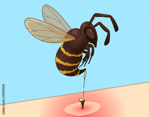 Bee sting. Injury after a bee sting.  Redness on the skin. Closeup illustration. Healthcare illustration, vector illustration. 
