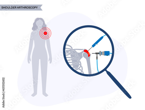 Shoulder arthroscopy poster