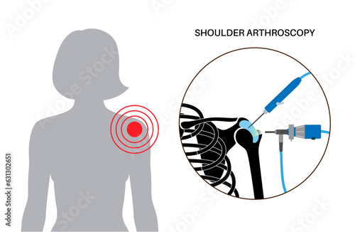 Shoulder arthroscopy poster