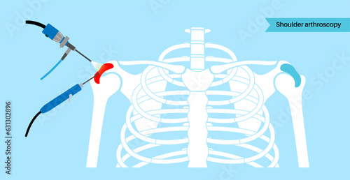 Shoulder arthroscopy poster