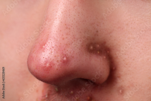 Young man with acne problem, closeup view of nose photo