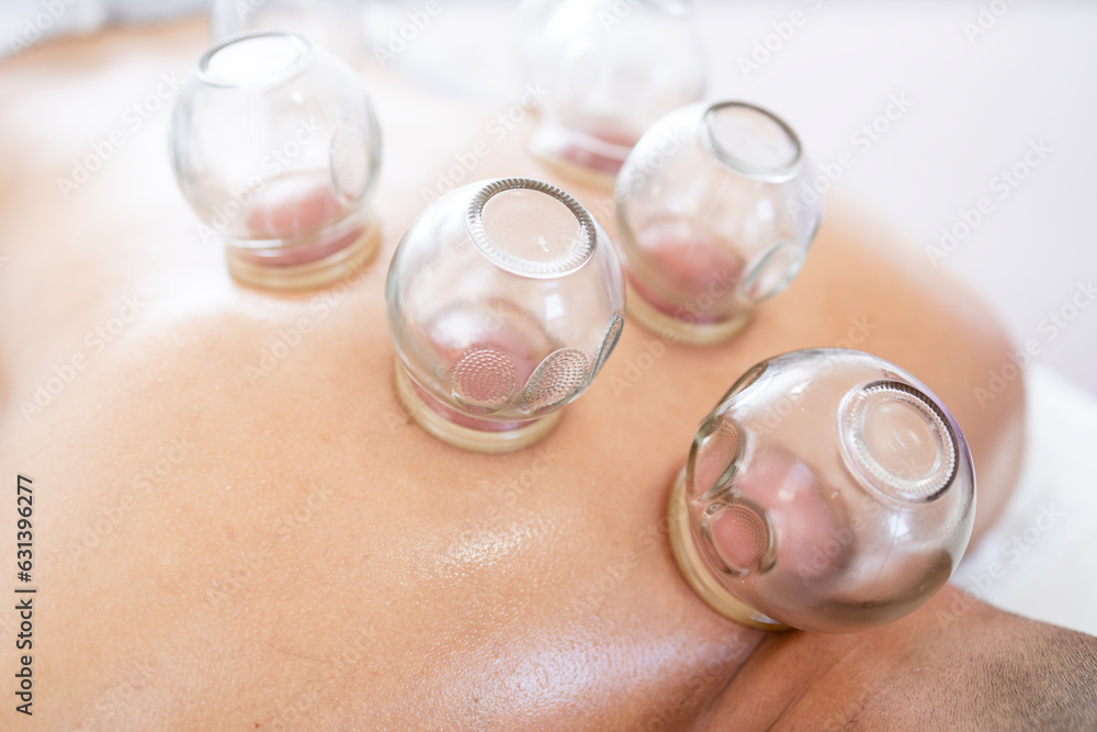 Close up view of patient back and hijama cupping technique. Close up view of patient back and hijama cupping technique.