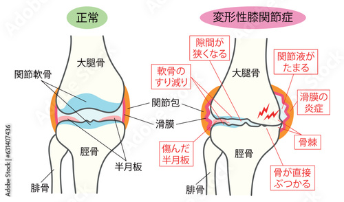 正常な膝関節と変形性膝関節症の比較説明イラスト