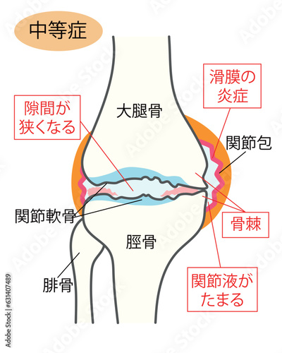 中等症の変形性膝関節症の説明イラスト
