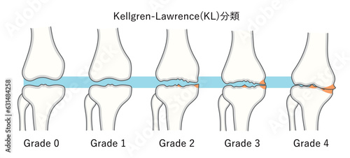 変形性膝関節症の進行度ケルグレンローレンス分類のイラスト
