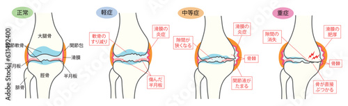 変形性膝関節症の進行度別説明イラスト