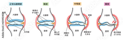 変形性膝関節症のシンプルな進行度別説明イラスト photo