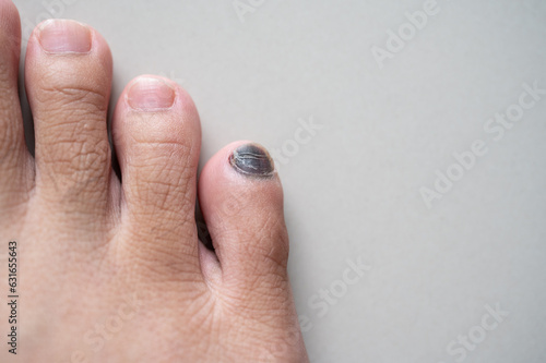 Cropped shot view of black nail called runner's toe. Runner's Toe can be described as toenail damage, and would occur when the toe is rubbing against the front of the shoe. photo