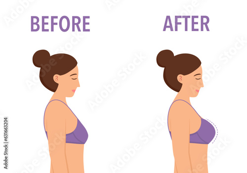 Female breast before and after plastic surgery in flat design on white background.