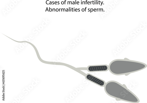 Abnormalities of sperm.