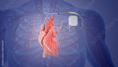 Permanent pacemaker implant medical concept	 photo