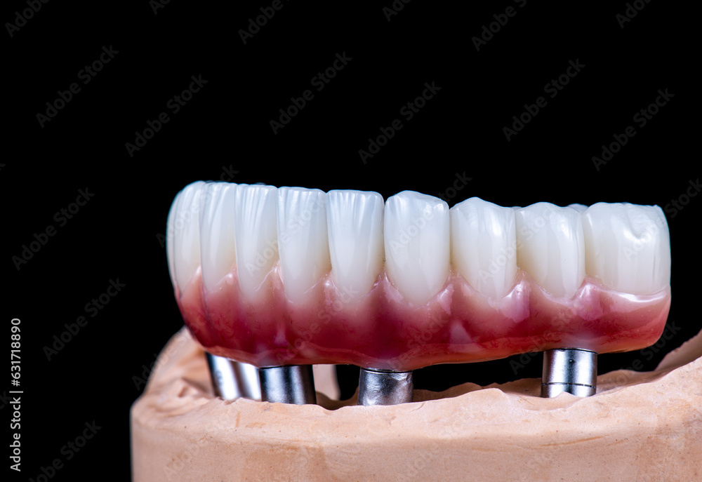 Obraz premium dental photography of full arch zircon bridge on implants