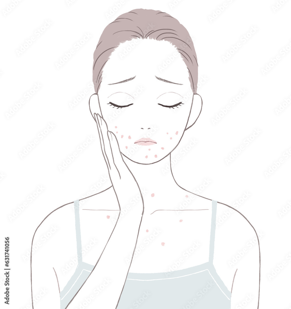 大人ニキビに悩む女性