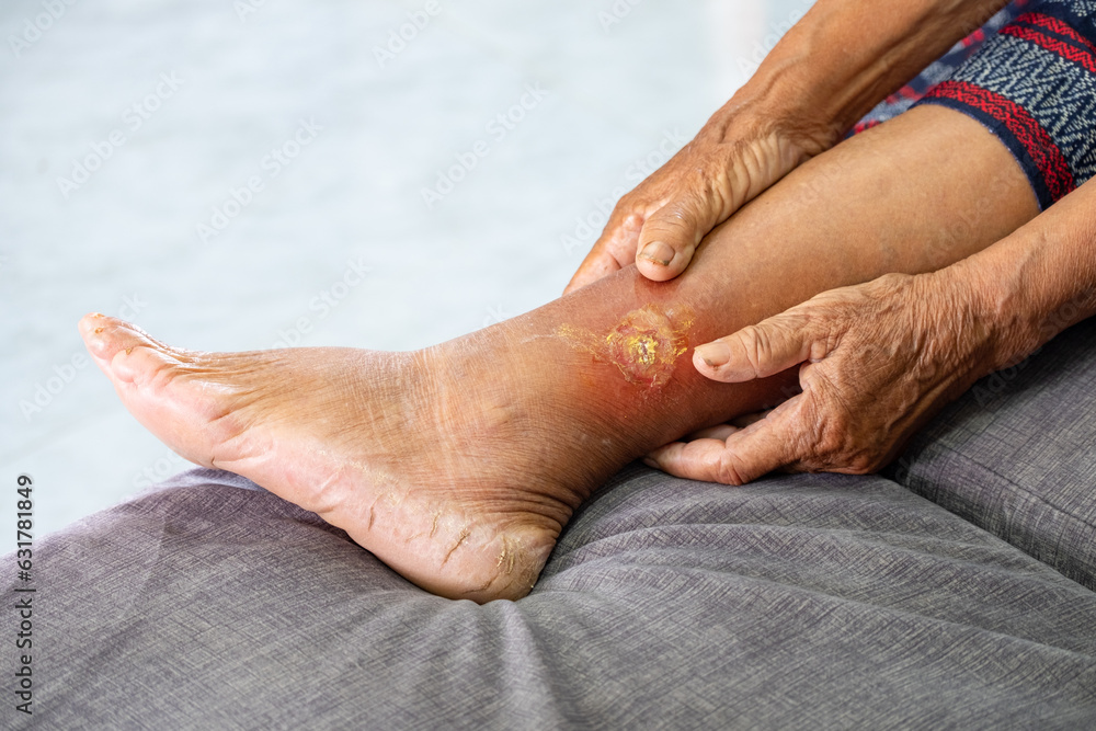 Fototapeta premium Asian elderly woman holding hands on her leg with gangrene due to diabetes, health care concept and occupational health