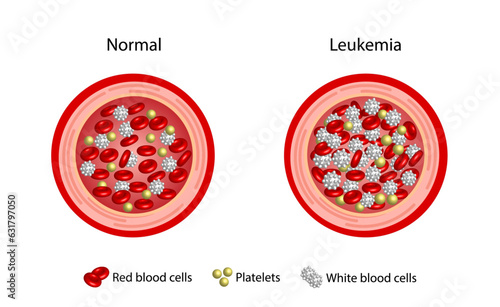 Leukemia, blood cancer. Difference between healthy normal blood and blood cancer. Blood vessel with leukocytes, erythrocytes, platelets and lymphocytes. Vector illustration.