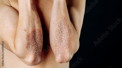 Acute psoriasis on the elbows is an autoimmune incurable dermatological skin disease. A large red  inflamed  flaky rash on the elbows. Joints affected by psoriatic arthritis