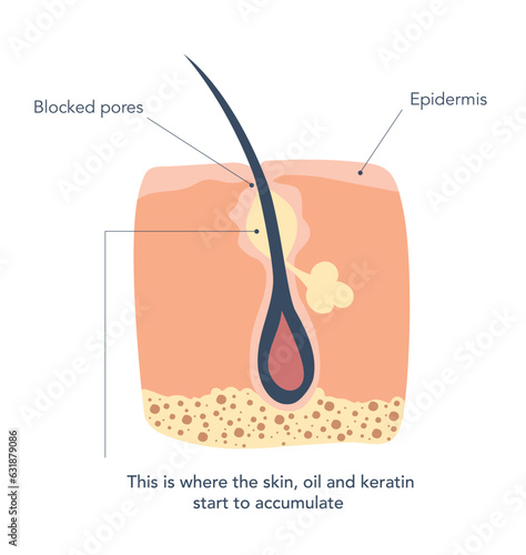 Inflamed skin around the hair follicles, 1st stage