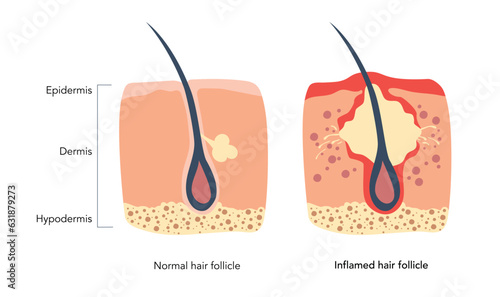 Inflamed hair follicle medical scheme zoomed