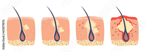 Stages of hair follicle inflammation in human body