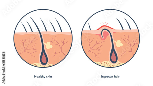 Ingrown hair medical scheme under microscope