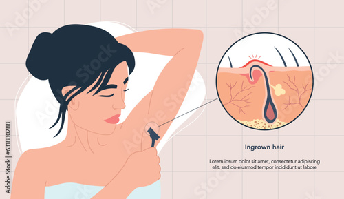Woman with ingrown hair inflammation after shaving