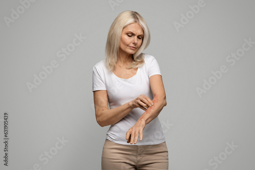 Unhappy mature woman scratching her irritated skin on arm photo