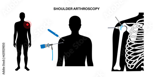 Shoulder arthroscopy poster