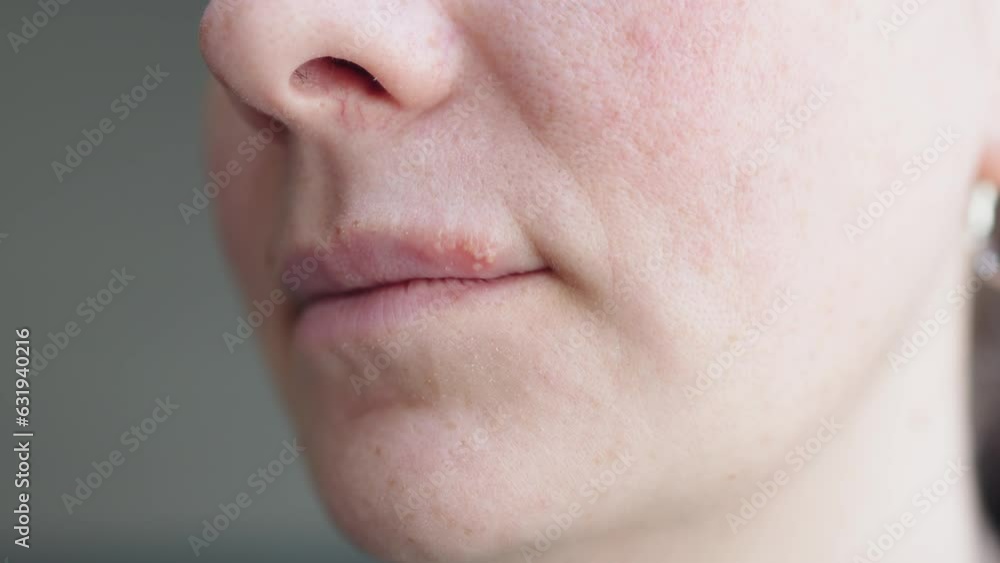 Video „virus herpes simplex on lip skin, sore vesicles cause