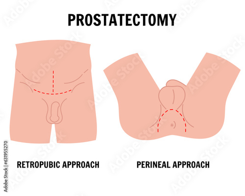 Medical infographic male prostatectomy in vector