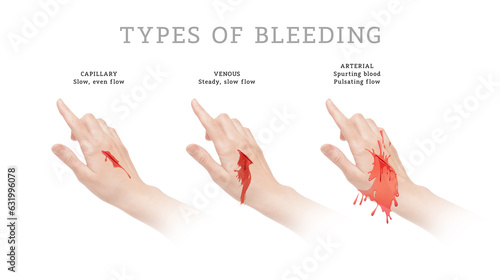 Three main types of bleeding photo