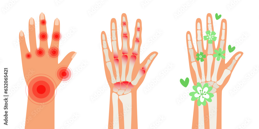 Rheumatoid Arthritis hands. Pain in the human body. Arthritis, bone disease medical poster. Finger arthritis vector illustration. Chronic skeleton pain Rheumatoid Arthritis hands. Pain in the human body. Arthritis, bone disease medical poster. Finger arthritis vector illustration. Chronic skeleton pain