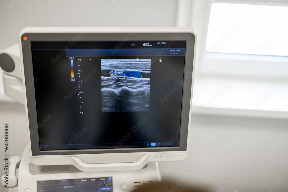Monitor during ultrasound examination of carotid artery Monitor during ultrasound examination of carotid artery