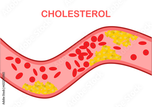 Cholesterol is a waxy substance found in your blood. Your body needs cholesterol to build healthy cells, but high levels of cholesterol can increase your risk of heart disease. 