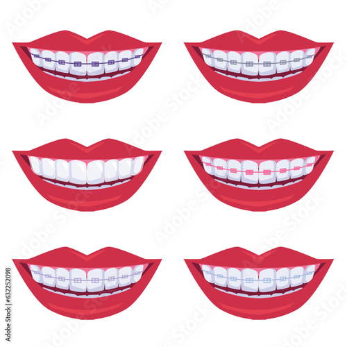 Happy smile with braces and clear aligners, set of red lips - flat vector illustration isolated on white background.