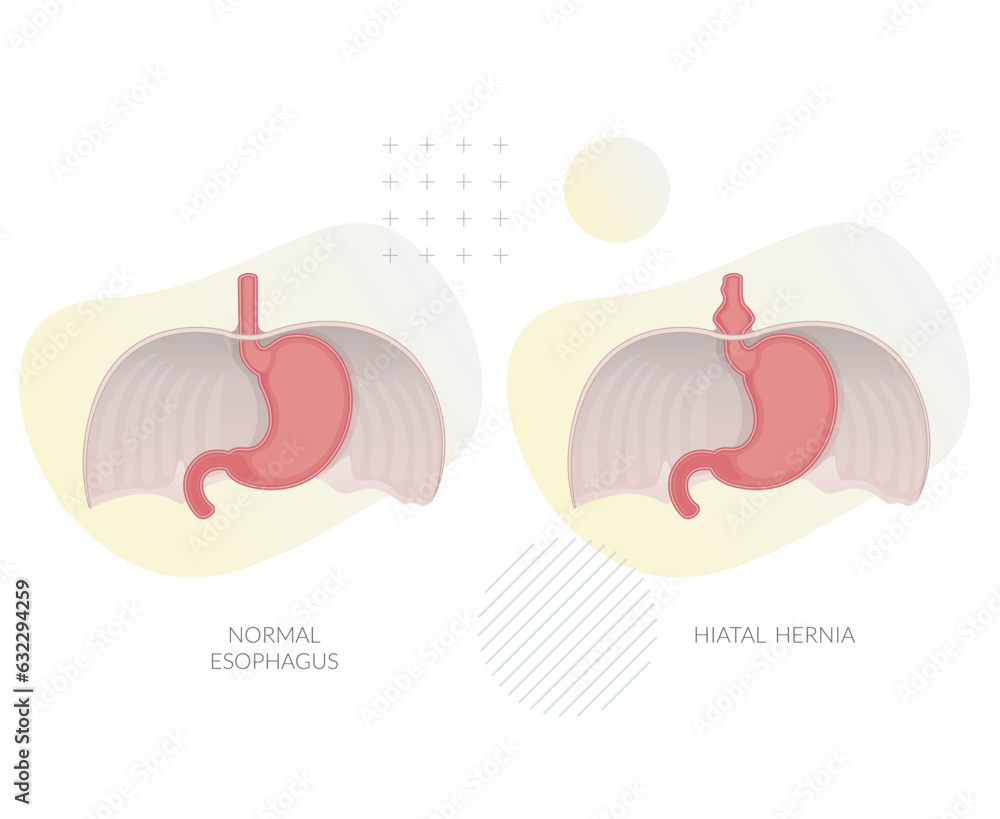 Hiatal Hernia Hiatus Opening in Diaphragm Stock Illustration Stock