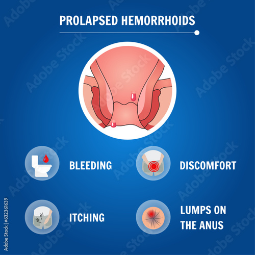 Medical cartoon of hemorrhage disease prolapsed hemorrhoids in vector illustration