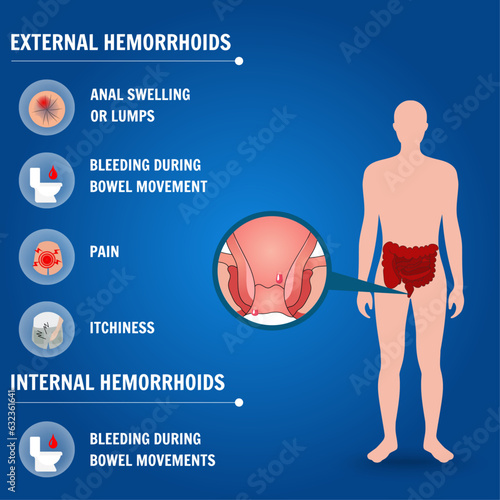 Medical information external and internal hemorrhoids in vector