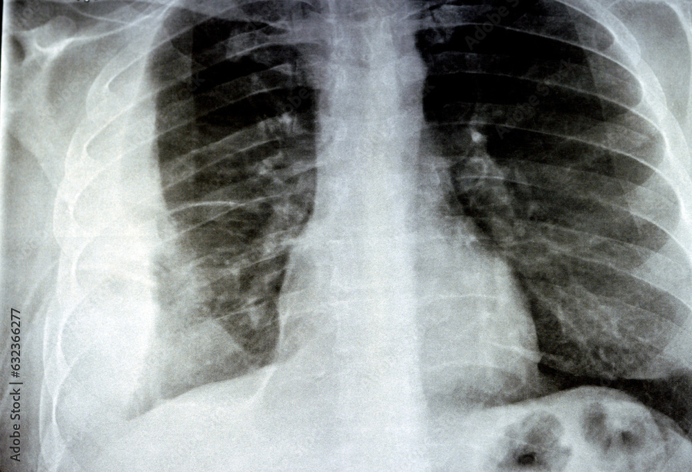 Plain X Ray For A Patient With Aspiration Pneumonia Right Lung Empyema