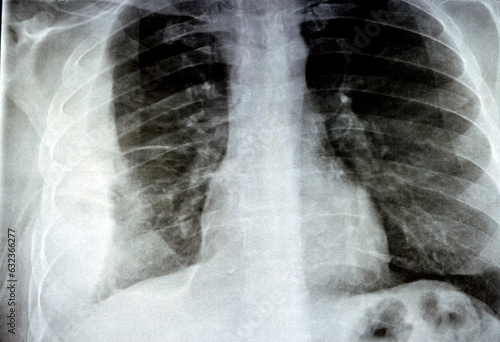 Wall Mural Plain X ray for a patient with aspiration pneumonia right lung, empyema, pleural