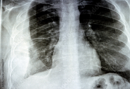 Plain X ray for a patient with aspiration pneumonia right lung, empyema, pleural effusion after insertion of a chest thoracostomy tube to drain the pus and the fluids with a slight improvement photo