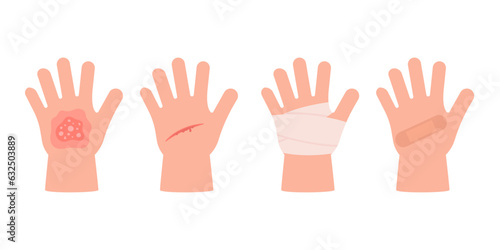 Physical injury child hand with burn of skin, open cut, bleeding wound. First aid clean bandage and patch. Vector